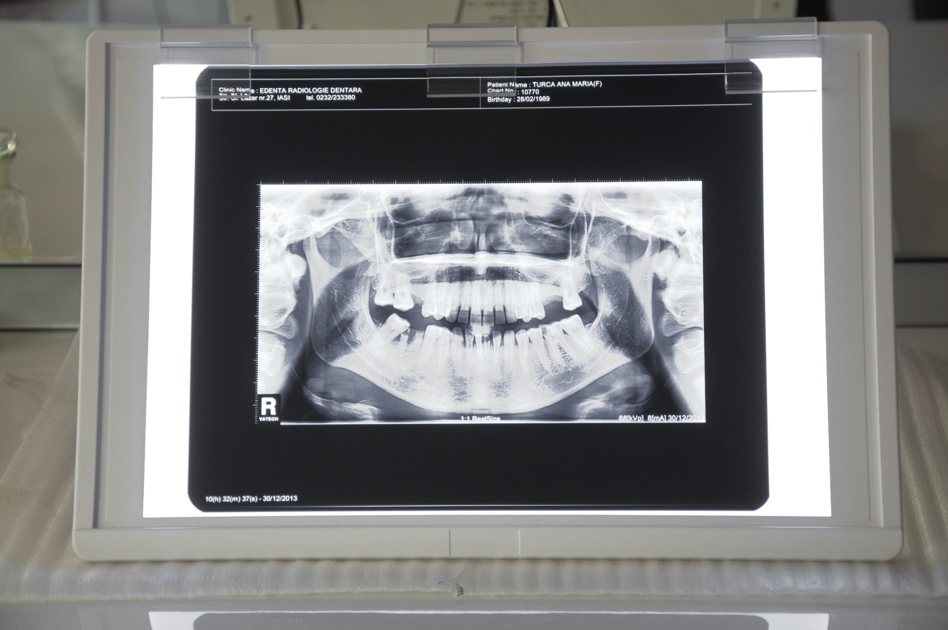 Protetică dentară (coroane și punți)